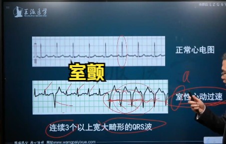 心电图进阶学习:室颤心电图读图技巧哔哩哔哩bilibili