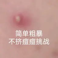 Tải video: 被封第N天，挑战不挤痘痘