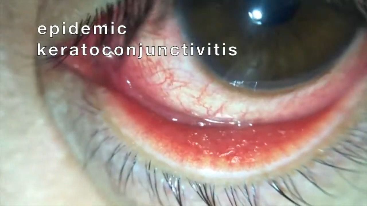 EKC (epidemic keratoconjunctivitis)  流行性角结膜炎哔哩哔哩bilibili