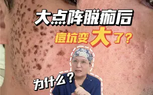 真的吗？点阵脱痂后坑变大的原因找到了！