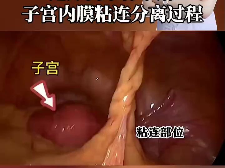 近距离带你了解子宫内膜粘连分离的过程哔哩哔哩bilibili