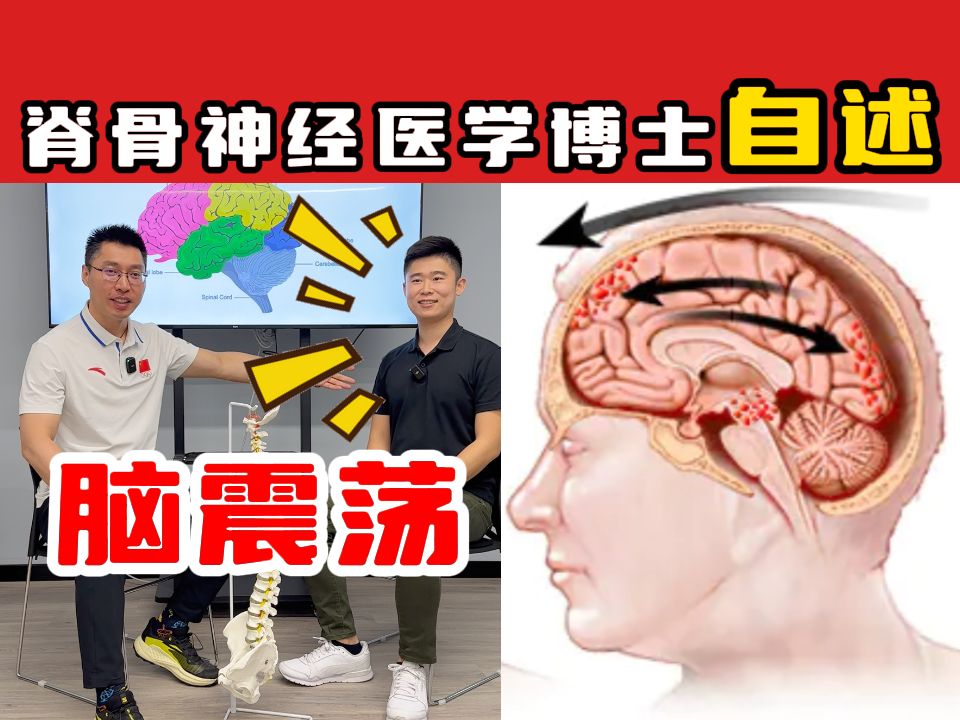 【一名脑震荡患者个人亲身经历】脑震荡 脊骨神经医学博士自述(下)哔哩哔哩bilibili