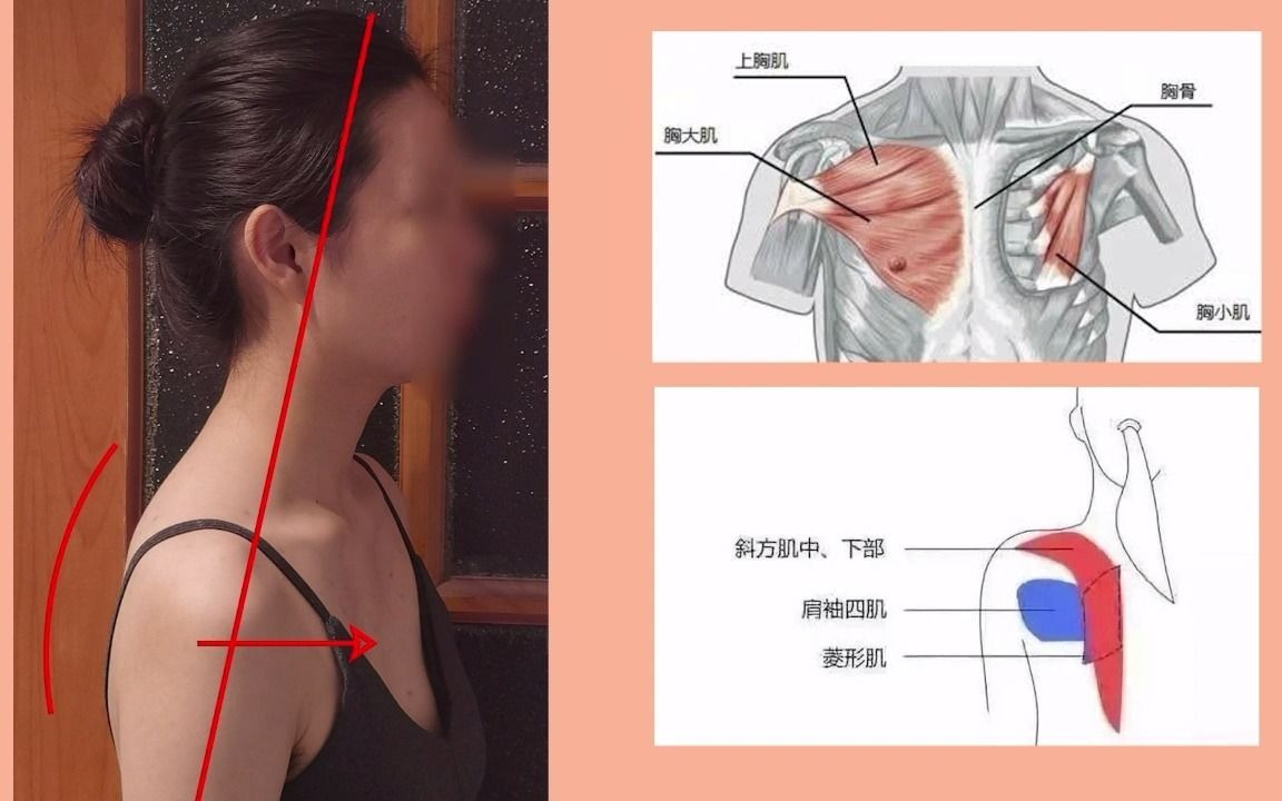 【每日科普】1分钟带你来了解脖子前倾,颈后大包,扣肩驼背如何矫正