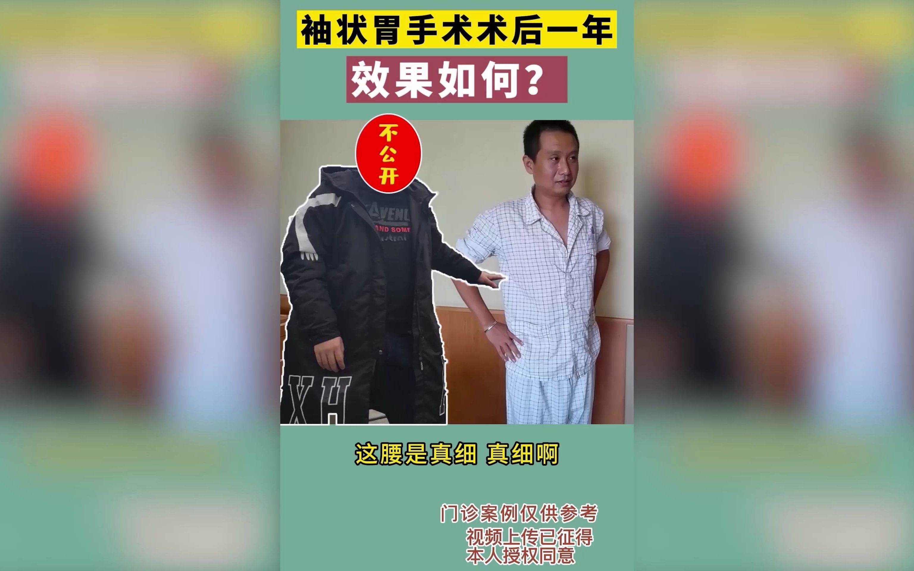 术前两百斤,一年瘦成“肌肉男”,医生:你这瘦的太可怜了(这位胖友不愿公开肥胖的照片)哔哩哔哩bilibili