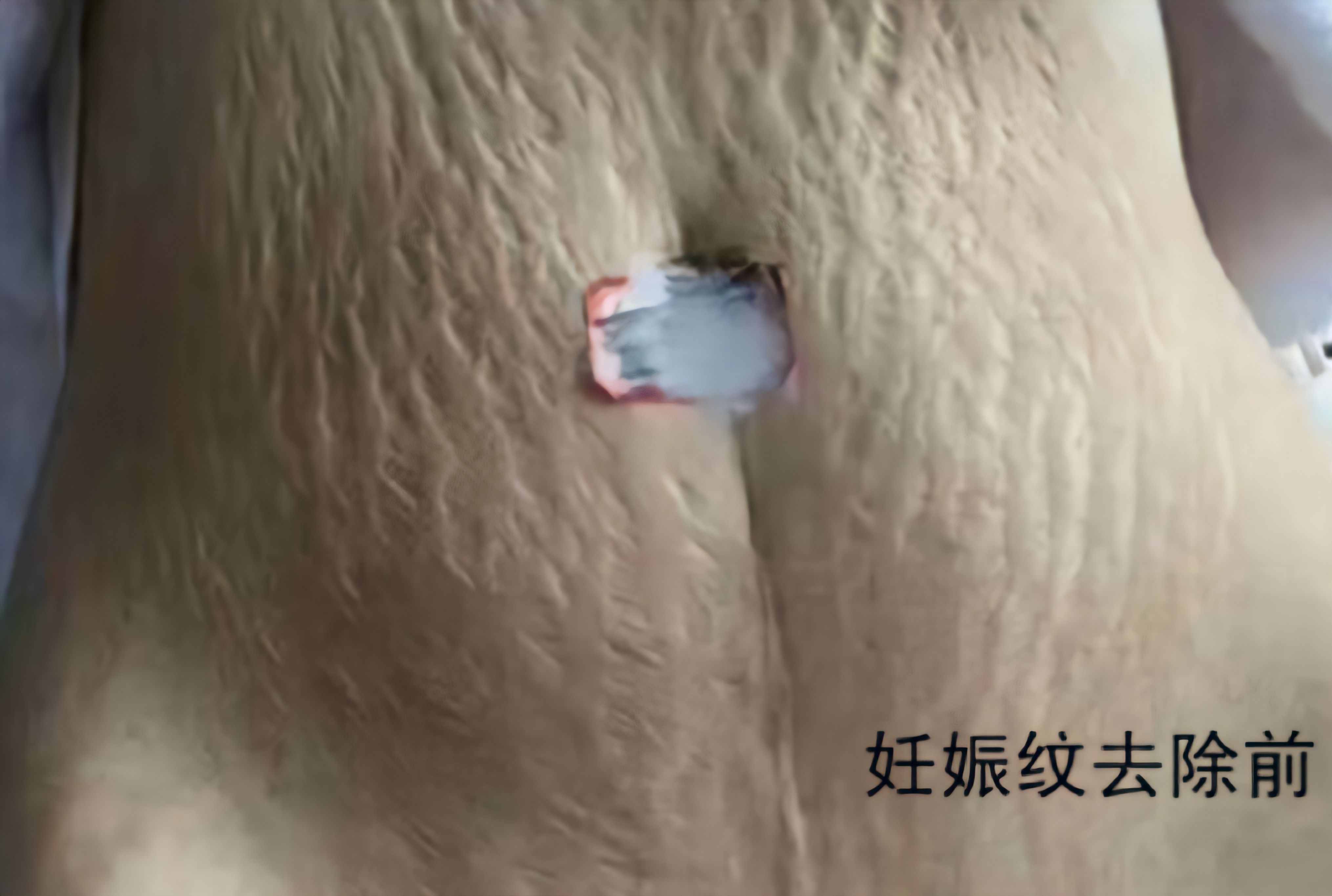 妊娠纹拜拜!3款热门淡纹产品评测,哪款是你的纹纹救星?