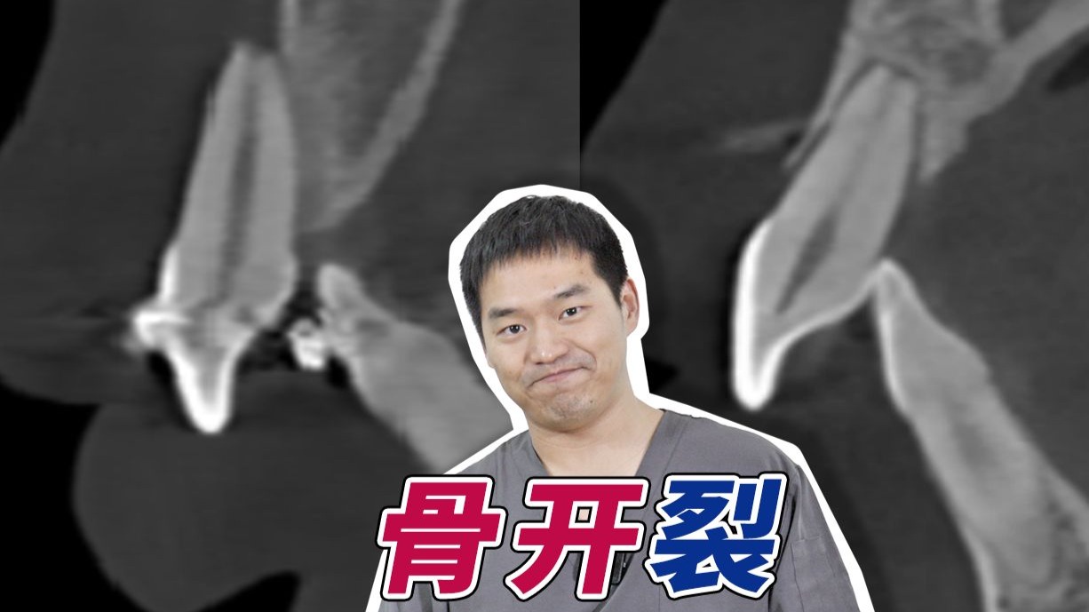 还有比这更离谱的骨开窗矫正病例吗