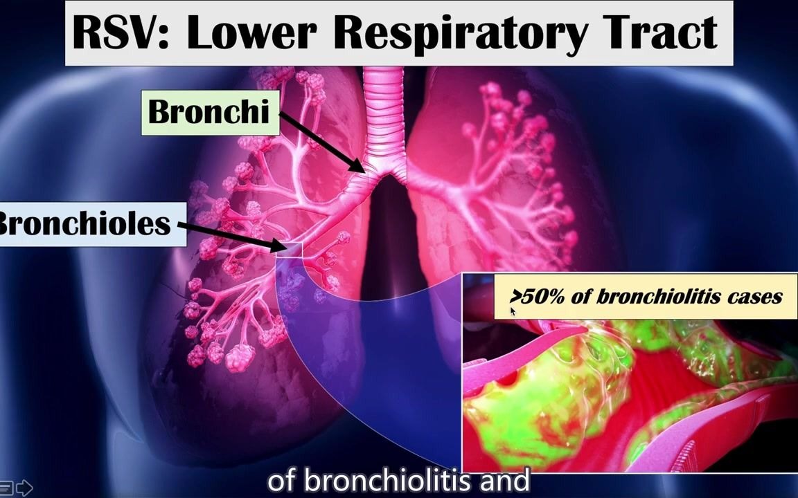 Respiratory Syncytial Virus (RSV)  What Is It & What Conditions Does it Cause哔哩哔哩bilibili