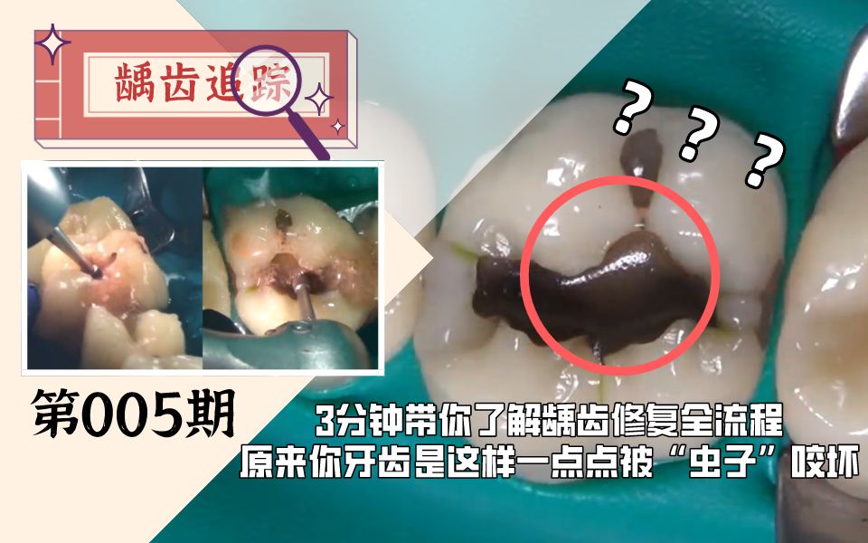 【龋齿追踪】3分钟带你了解龋齿修复全流程,原来你的牙齿是这样一步步被“虫子”咬坏的... ...哔哩哔哩bilibili