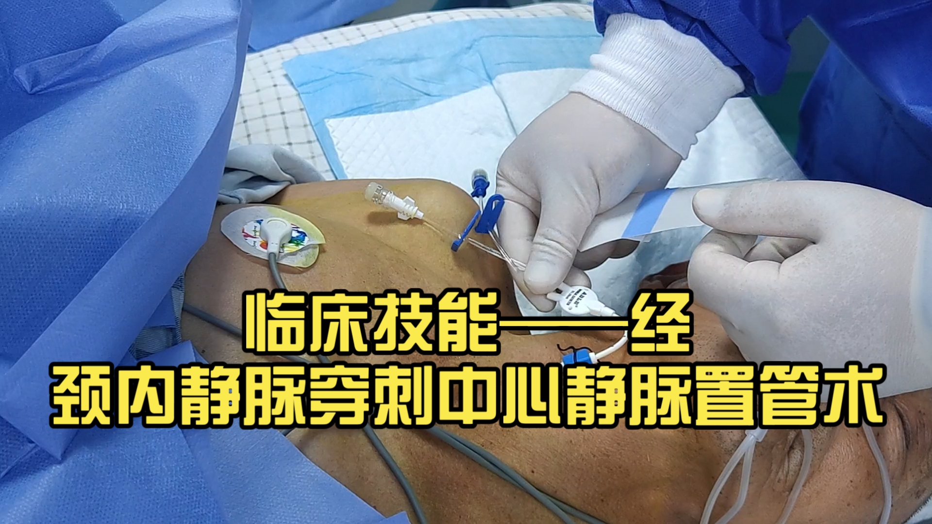 临床技能：经颈内静脉穿刺中心静脉置管术（CVC）