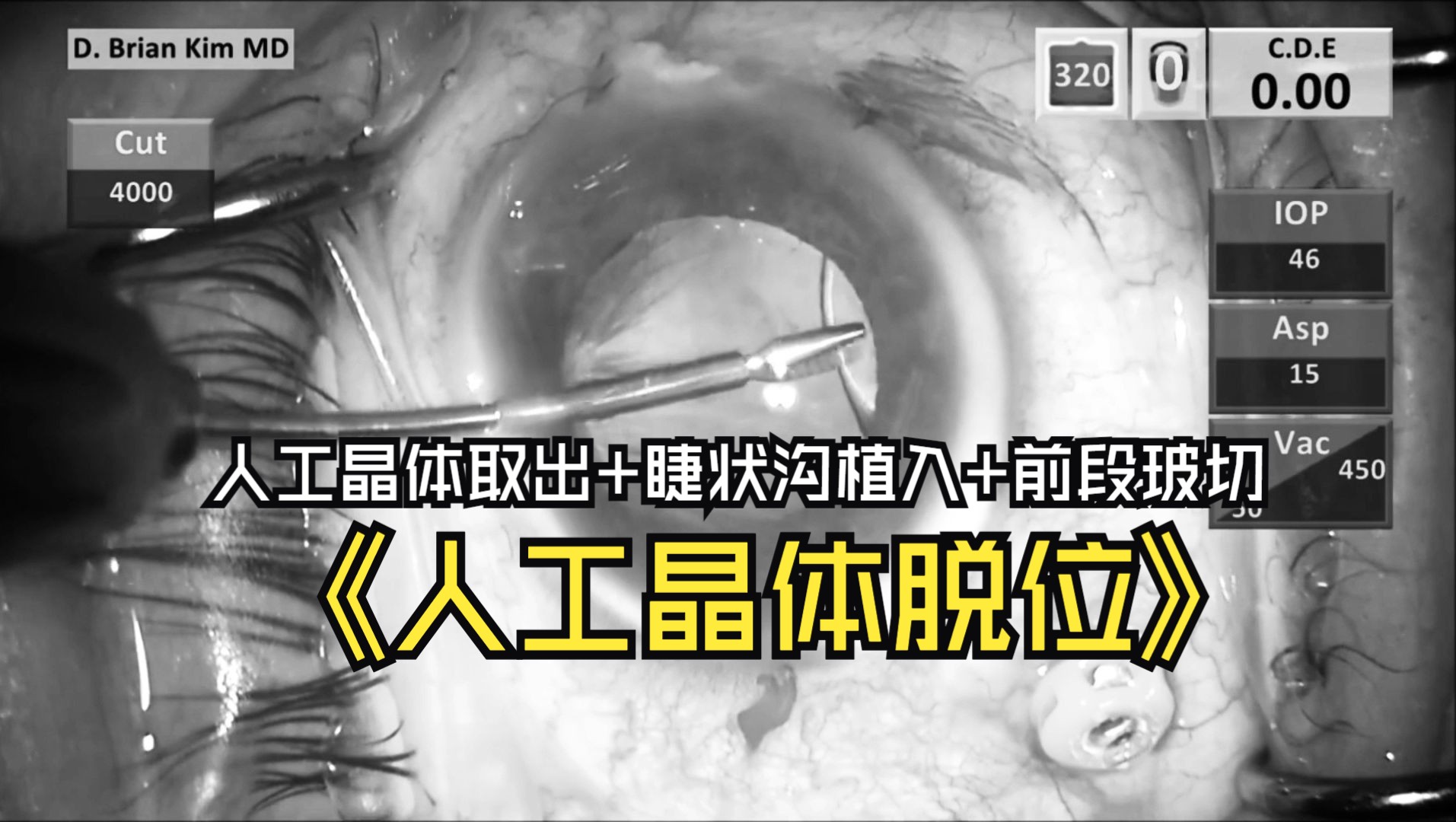 【人工晶体脱位】dislocated iol_ whats my next plan of action bw