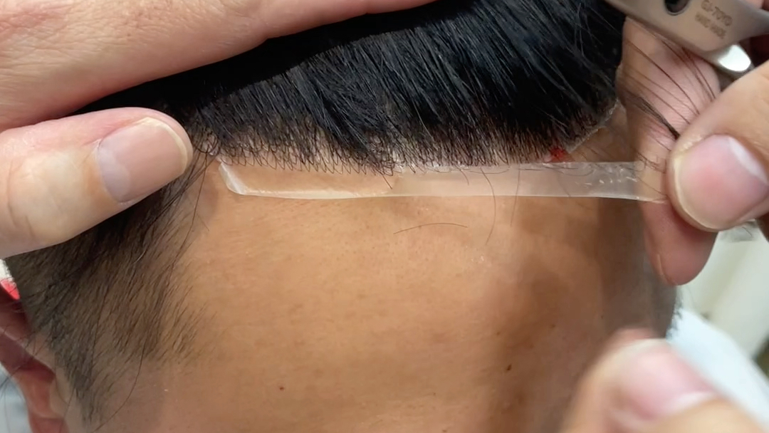 在夜场工作的兄弟因为长期熬夜脱发厉害所有头顶发量稀