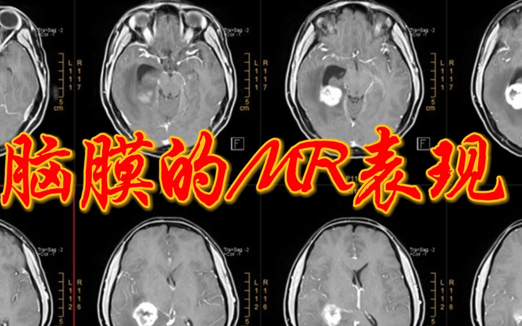 【MRI&Coka】脑磁基础知识@脑膜及病变@磁共振@221220哔哩哔哩bilibili