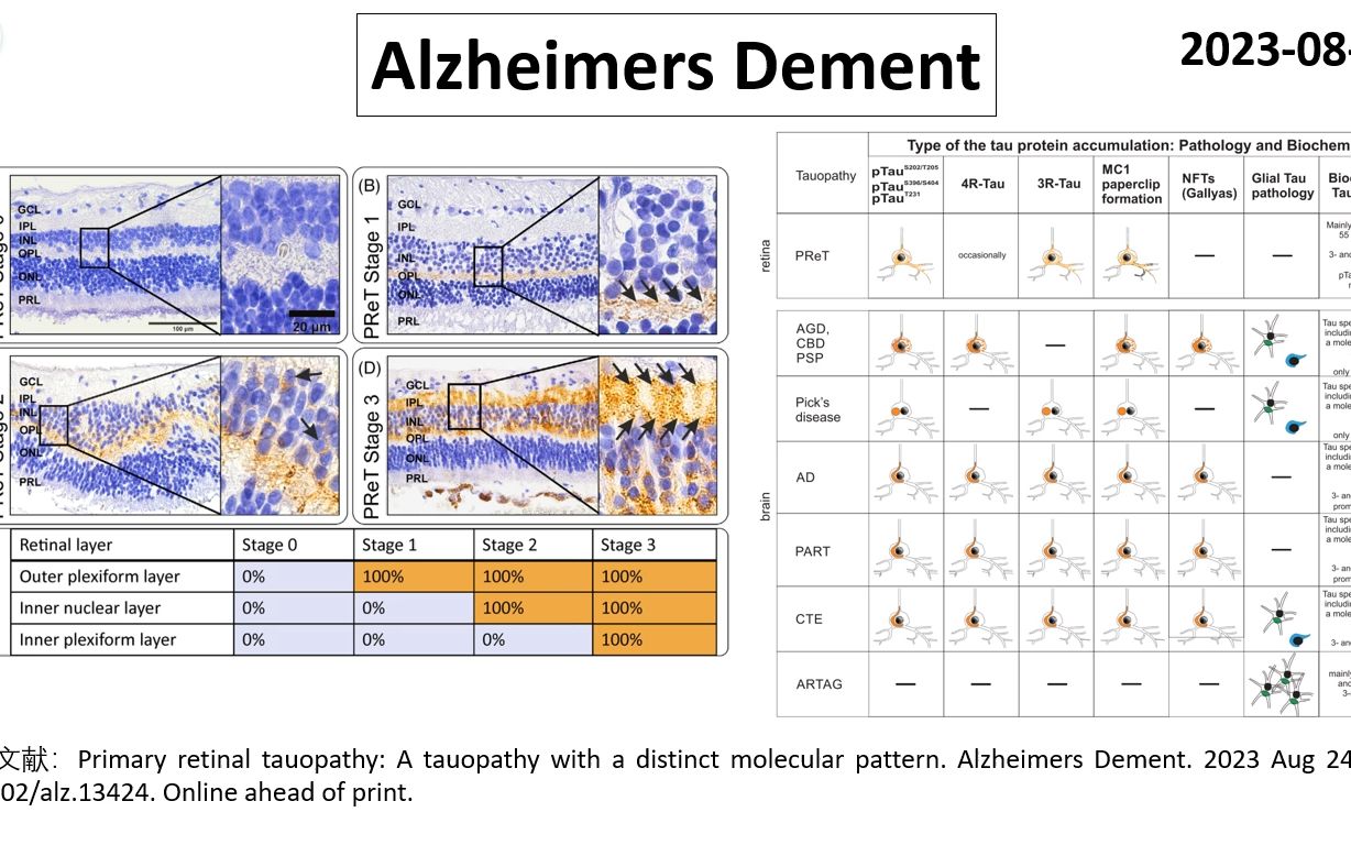 Alzheimers Dement—视网膜也有Tau蛋白病哔哩哔哩bilibili