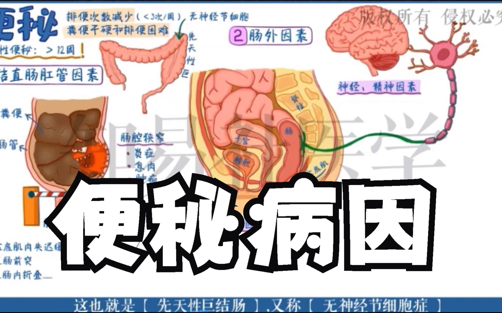 医学手绘演绎 便秘的各种病因哔哩哔哩bilibili