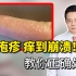 汗疱疹钻心的痒！别再抓啦，医生教你正确处理