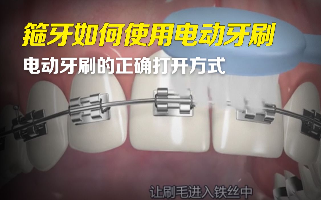箍牙期间如何使用电动牙刷？论电动牙刷的正确打开方式（含注意事项）