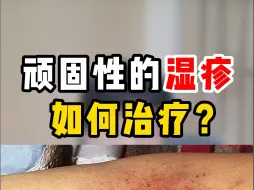 下载视频: 顽固性的湿疹，怎么办？