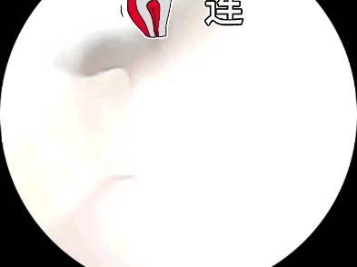 采耳鼓膜硬片哔哩哔哩bilibili