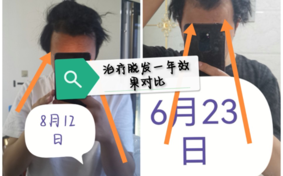 【拯救发际线】【脱发治疗一年】效果对比图!哔哩哔哩bilibili