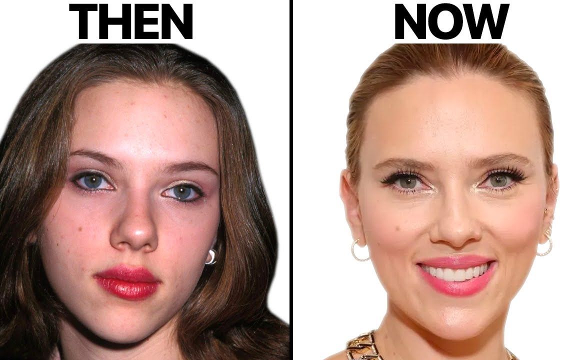 专业整形医生分析"寡姐"斯嘉丽约翰逊脸上的变化