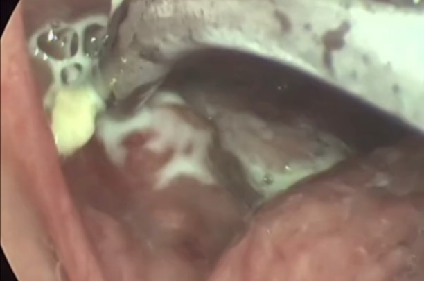 口腔挤出大量结石!