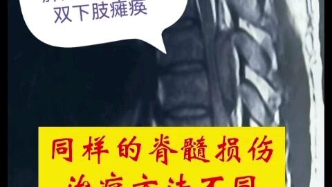 两个病人两种不同的治疗方法 效果相差甚远 脊髓损伤 哔哩哔哩