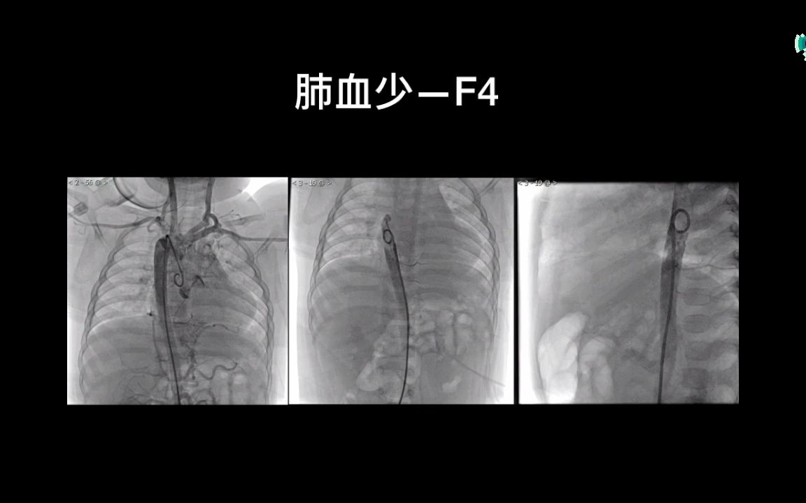 影领李宇:心血管疾病的形态与血流下哔哩哔哩bilibili