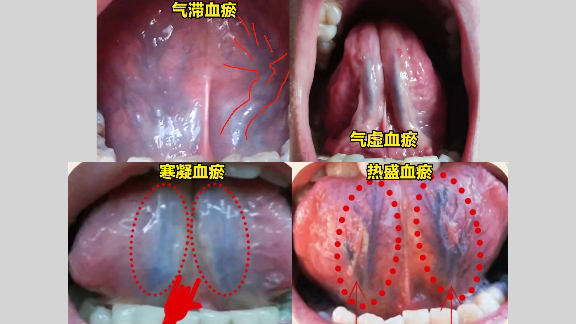 [图]舌诊同样是瘀血 ，病因却不同，气滞生瘀，热盛生瘀，寒凝血瘀，气虚生瘀，你知道自己是哪种瘀吗？