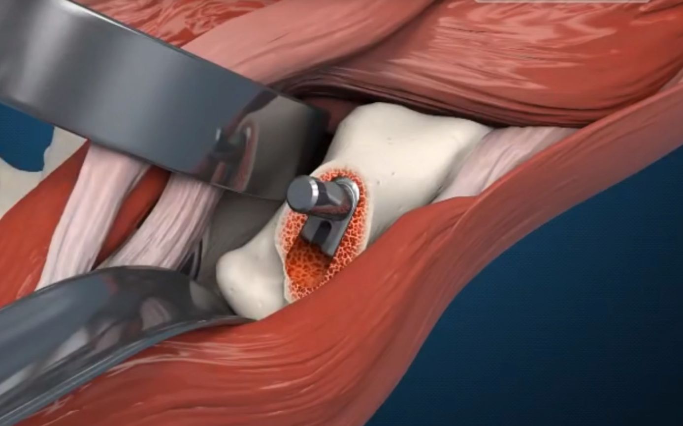 3D医学演示:股骨头坏死,人工髋关节置换手术全过程哔哩哔哩bilibili