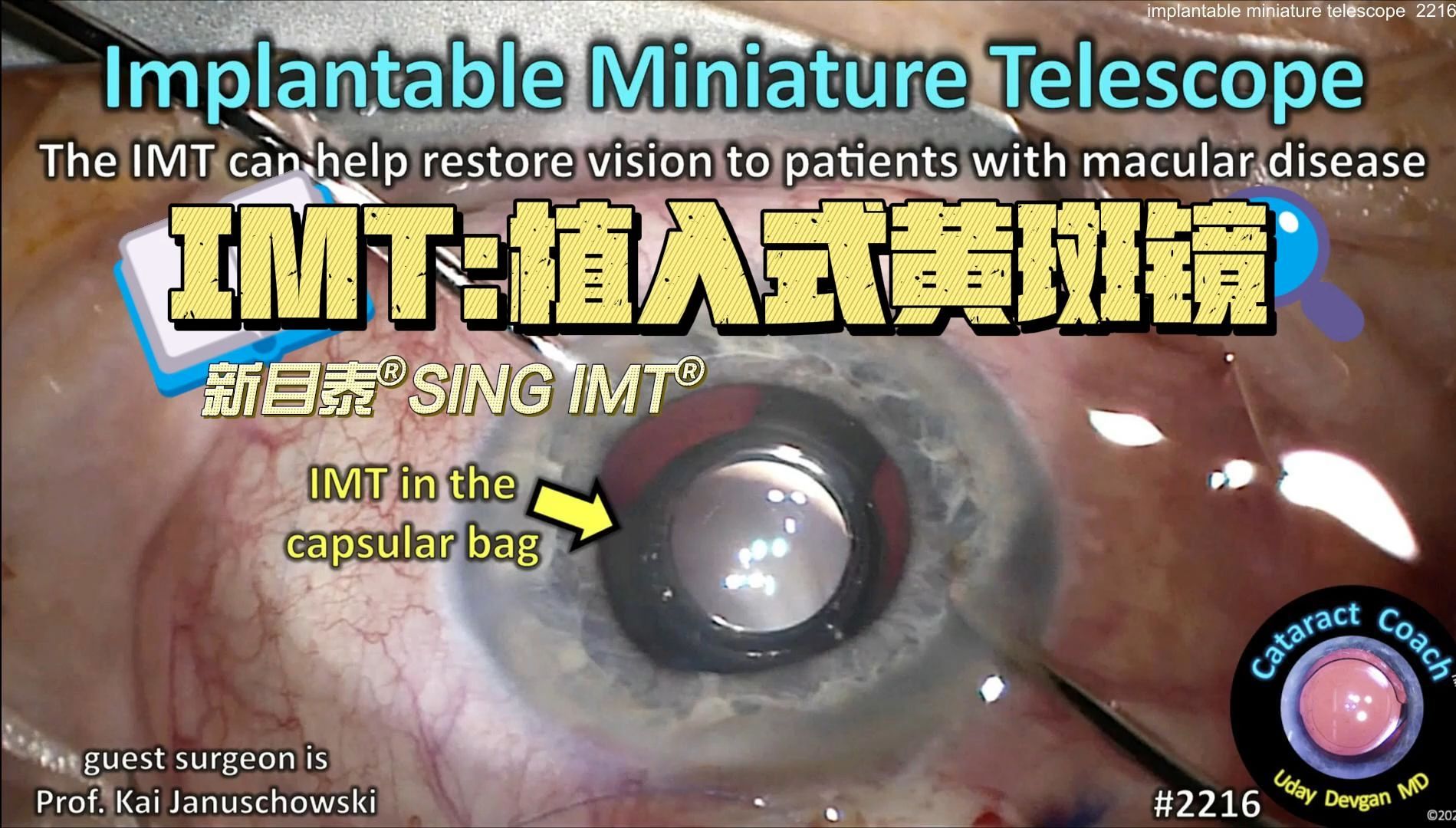 【中英】【特殊白内障手术:植入式微型黄斑镜IMT】implantable mini telescope IMT for macular degeneration哔哩哔哩bilibili