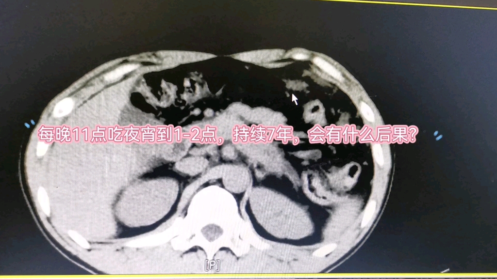 [图]每晚11点吃夜宵到1-2点，持续7年，会有什么后果？