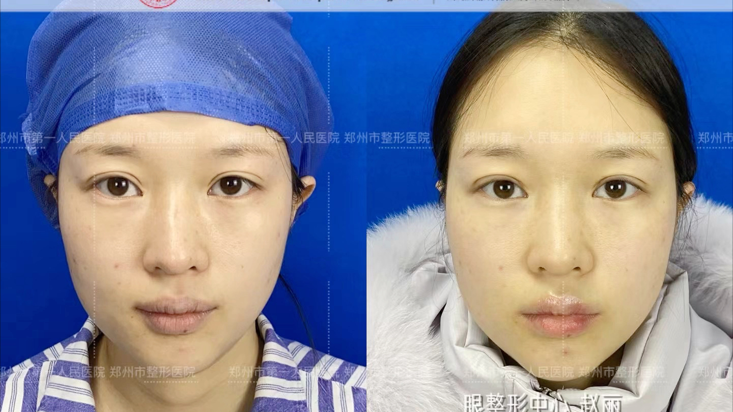 全切双眼皮修复术后一个月反馈
