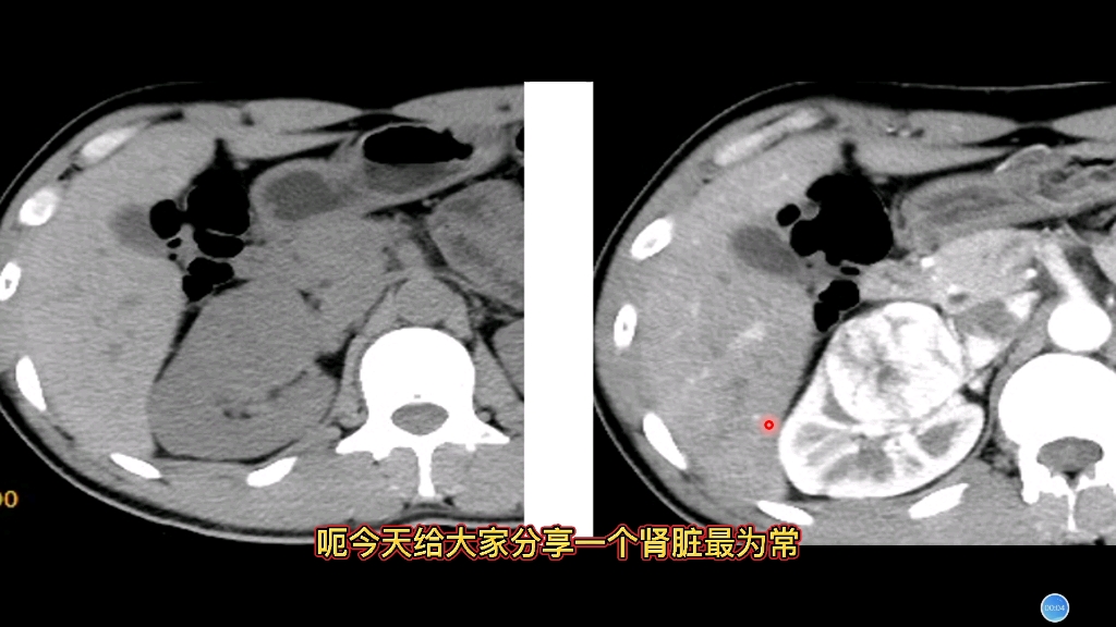 肾脏典型病例分享:肾实质内“快进快出”强化病灶,诊断什么?哔哩哔哩bilibili