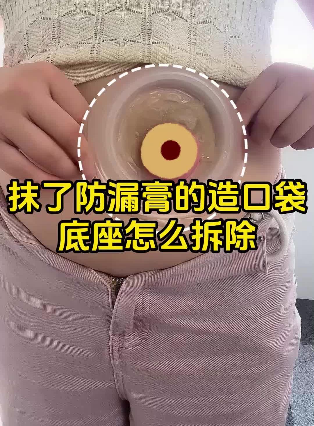抹了防漏膏的造口袋底座怎么拆除