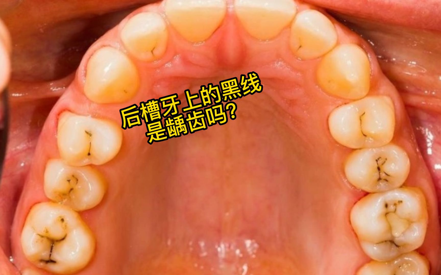 [图]后槽牙上的黑线是龋齿吗？