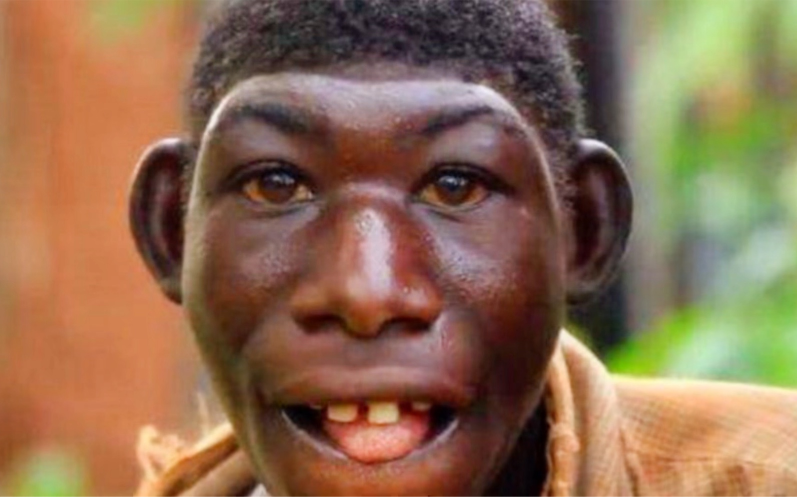 非洲"猴孩"艾力:长相返祖,以水果为食物,被同村人当动物欺凌(1)