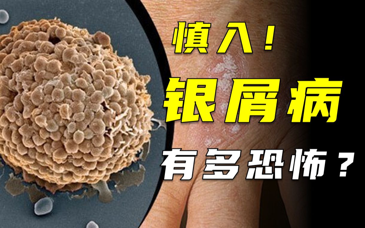 免疫系统异常激活,皮肤获得快速生长的能力,结果如何?哔哩哔哩bilibili