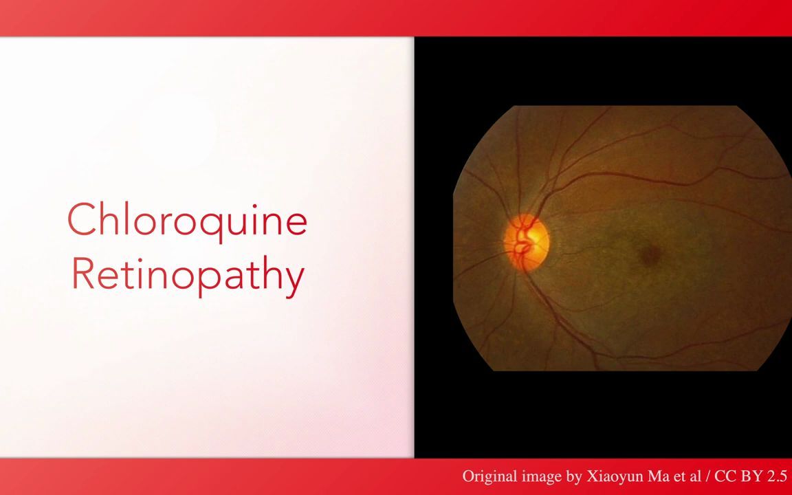 Fundoscopy Quiz:Low Difficulty眼底阅片小测试:低难度篇哔哩哔哩bilibili