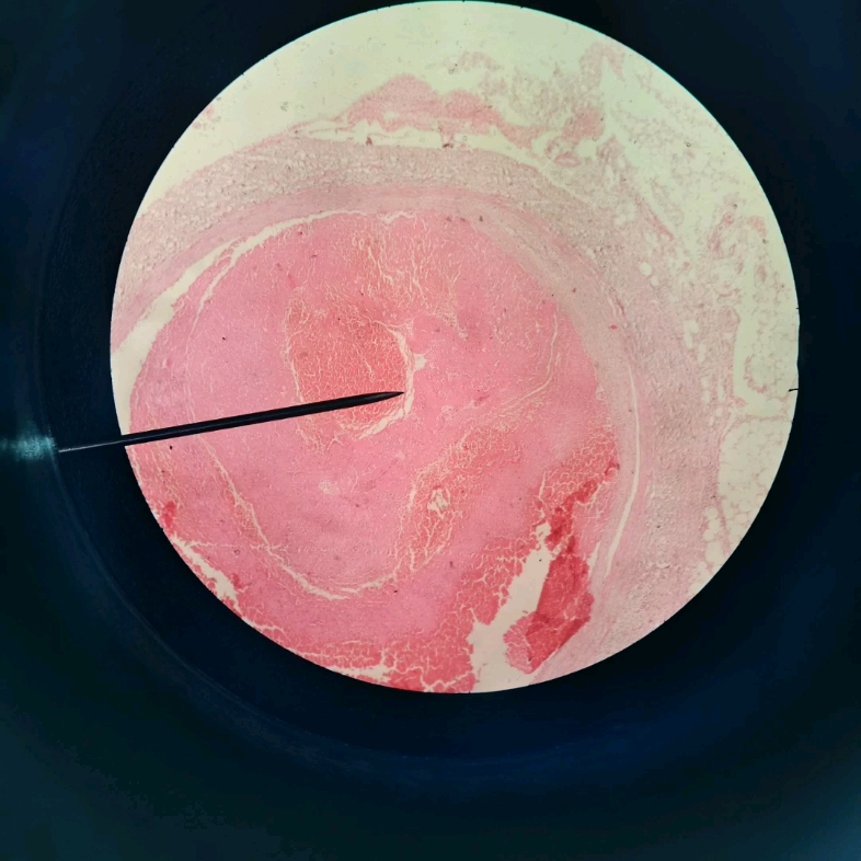 血管内混合血栓图片图片