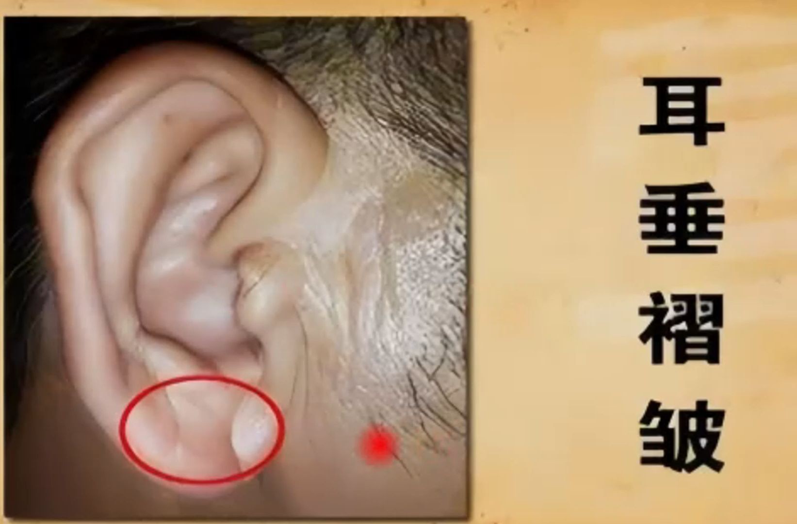 罕见的耳垂横纹,会破财吗?