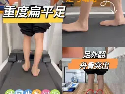 Download Video: 12岁男生重度扁平足，在行走时候明显看到足弓塌陷，呈现低平状态，运动表现差，运动后容易出现足部疼痛。