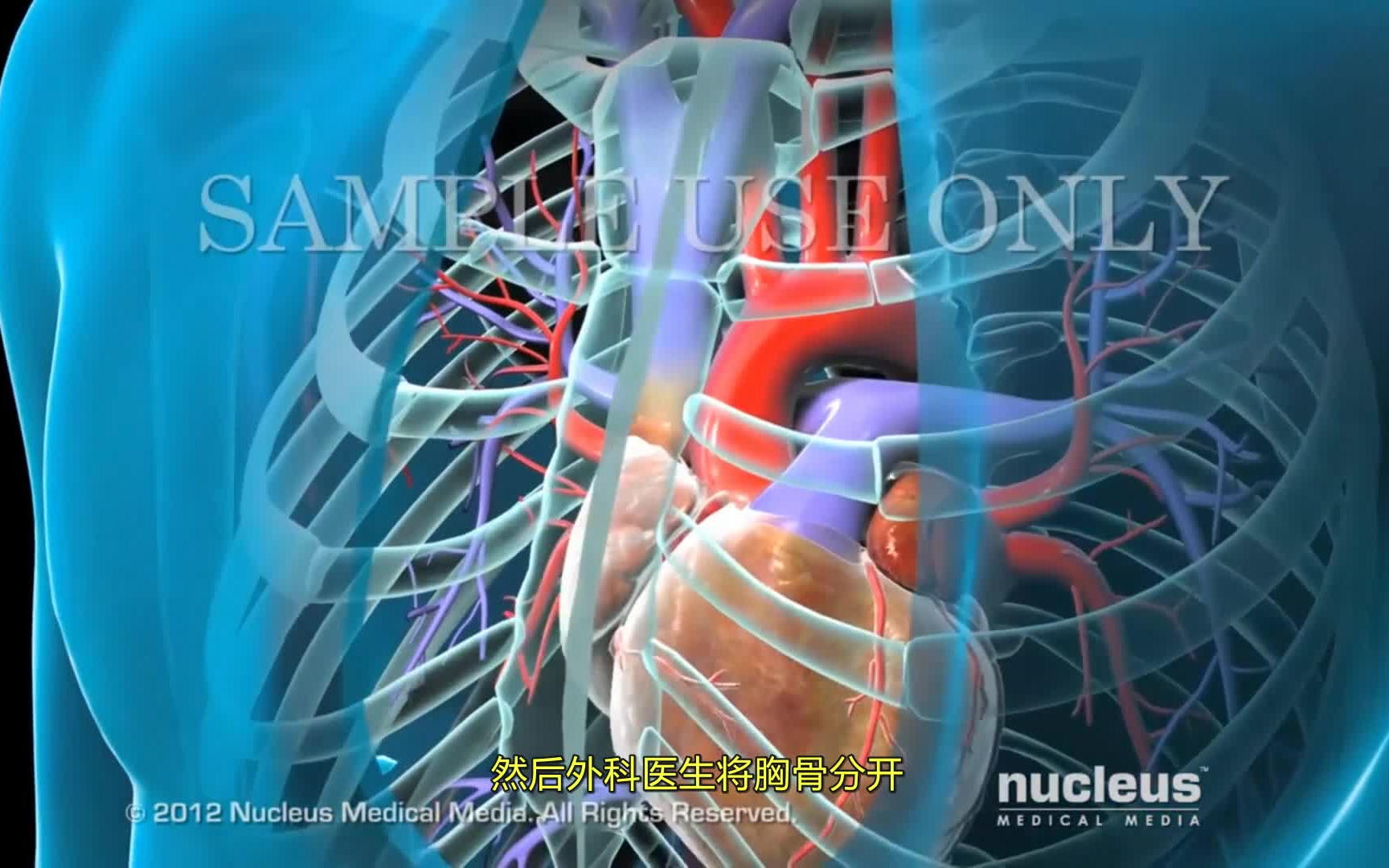 【3d医学动画】主动脉瓣置换(中文字幕 英文字幕)