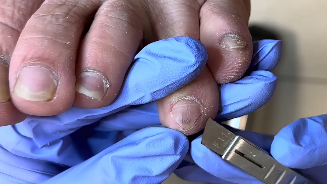 这个脚趾甲还是比较正常的