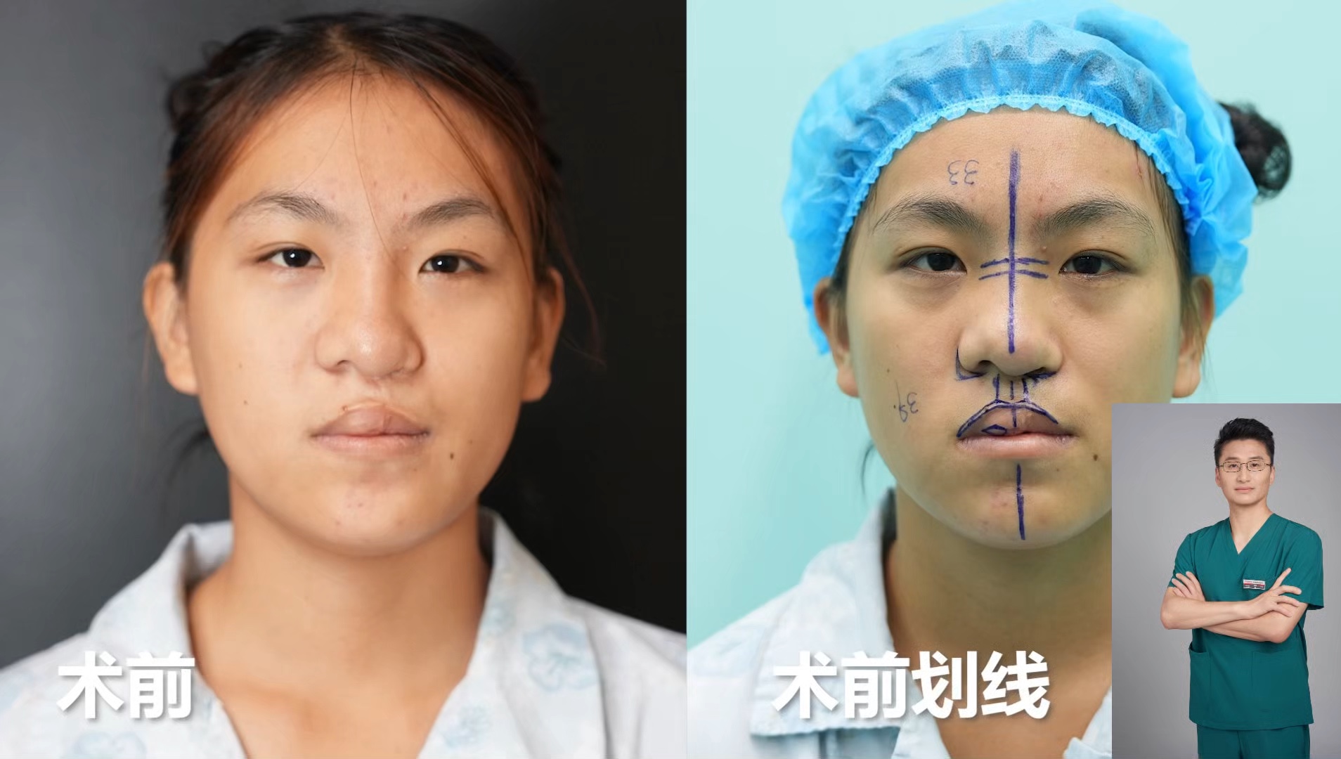唇裂鼻畸形修复