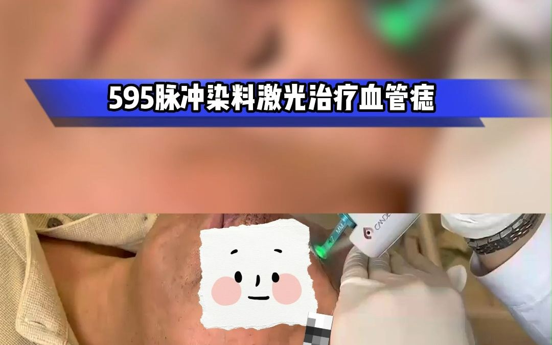 595脉冲染料激光治疗血管痣