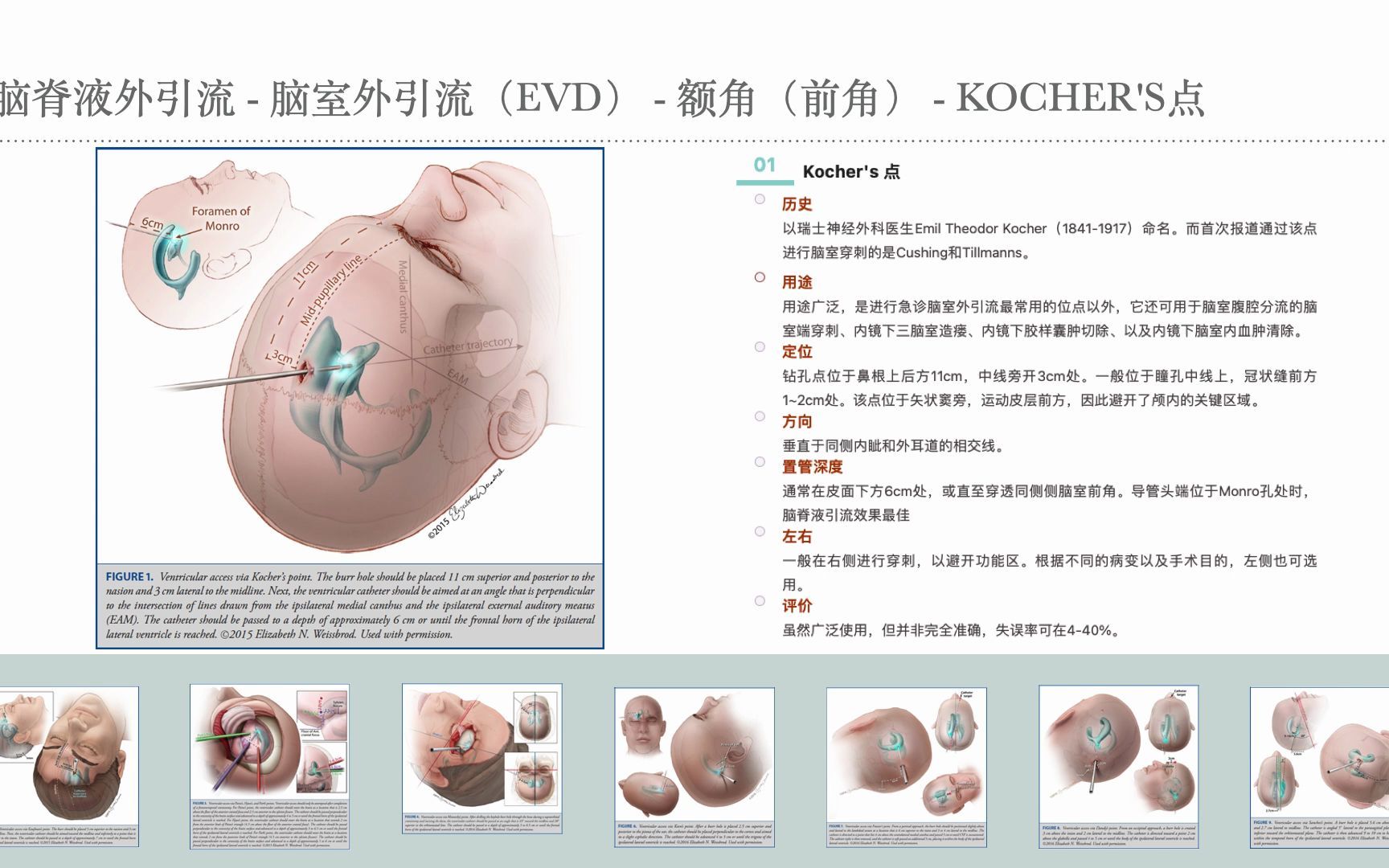 规培结业考核(神经外科学)技能操作第五站5.5 脑室穿刺外引流哔哩哔哩bilibili