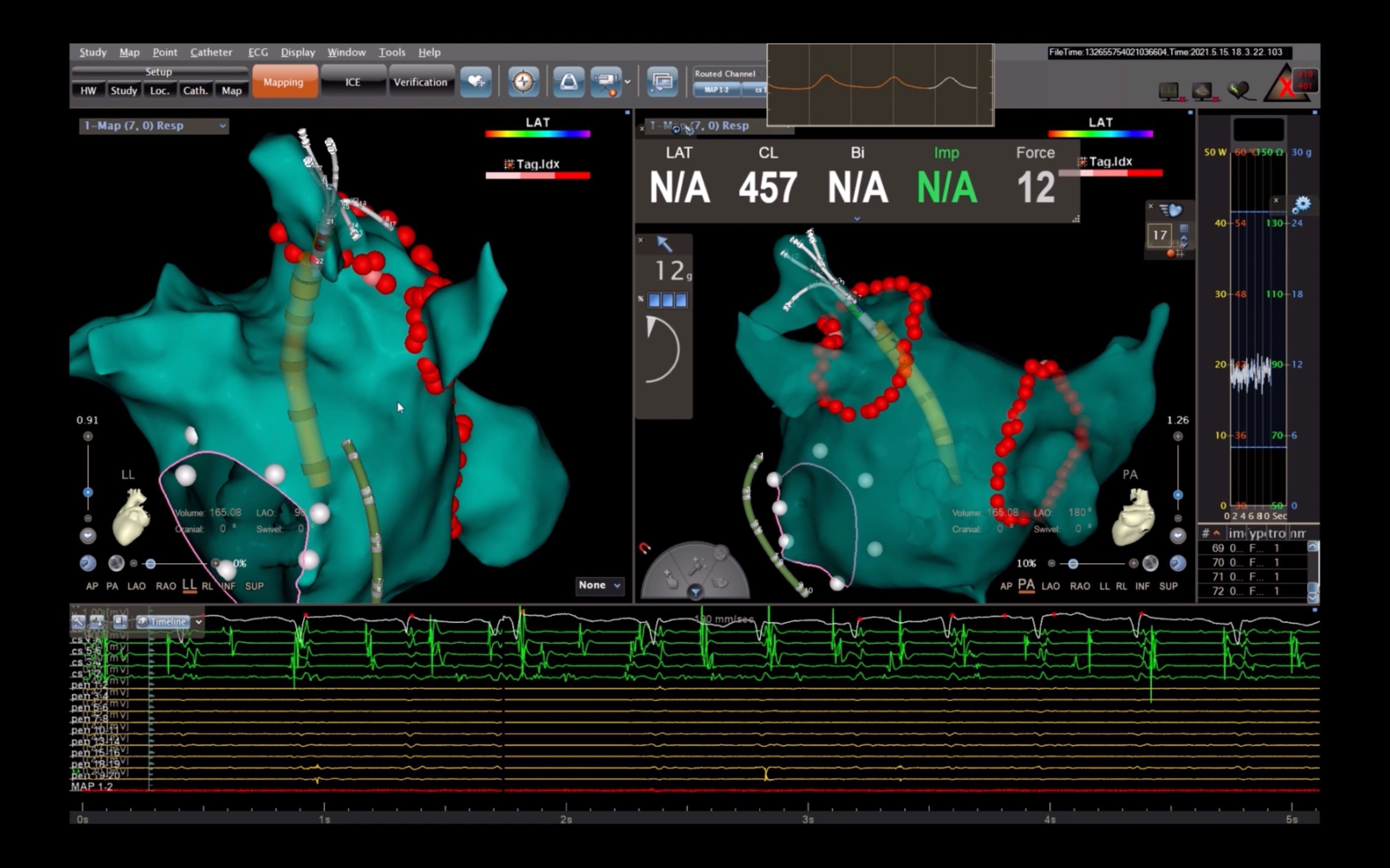 心脏电生理-pvi后验证肺静脉隔离(vizigo)
