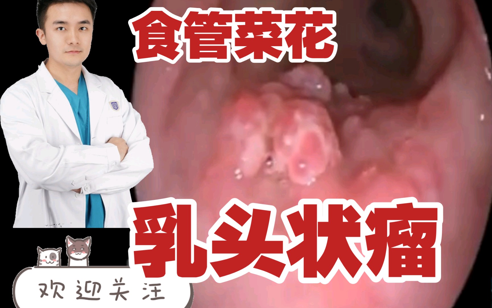 [图]食管里长“菜花”，是一种什么体验？HPV相关，更容易癌变！