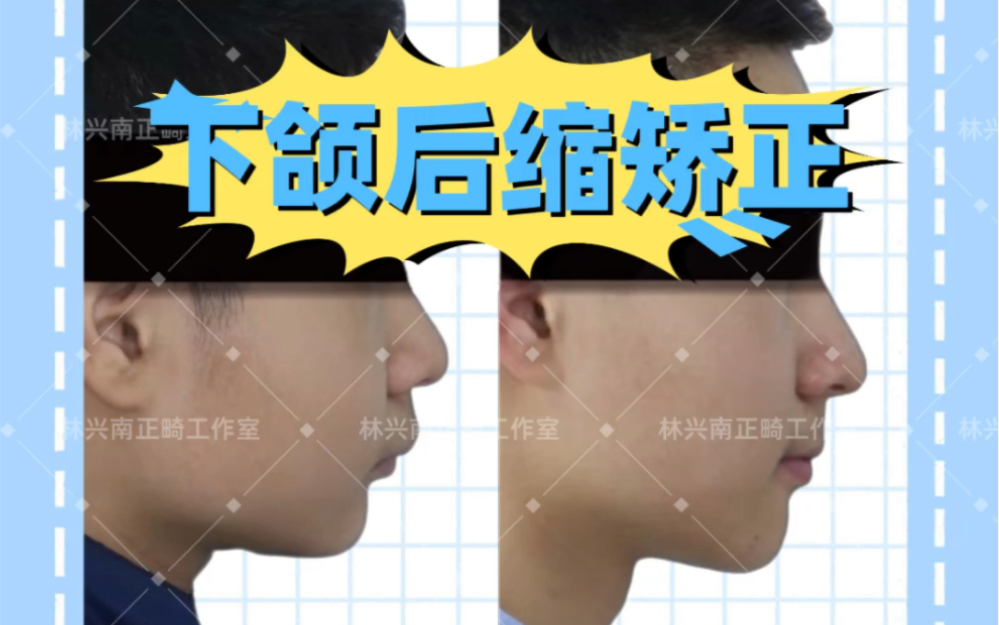 下颌后缩患者绝对不能错过的矫正年龄!