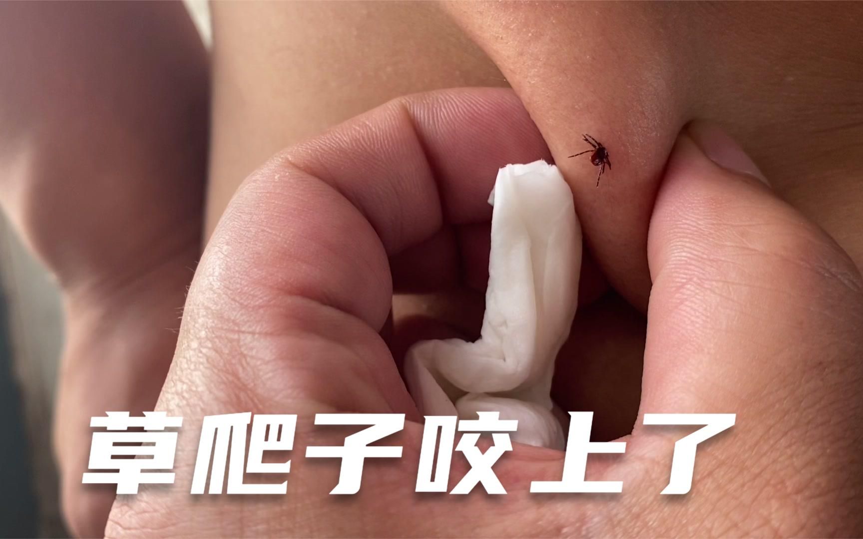 跑山人经常被草爬子给叮上今天也被咬上了土方法分享给大家